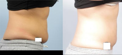 Coolsculpting - Zeltiq - 	Before and 5 weeks after coolsculpting (2 zones). Patient lost 4 pounds during this time from diet and exercise.