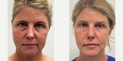 45-54 year old woman treated with Lower Facelift - This patient was able to achieve a more defined jawline as well as improved facial symmetry and youtfulness following treatment with Facelift, Lip lift, Lower Blepharoplasty, and Chin Augmentation.