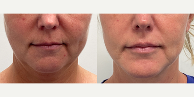 45-54 year old woman treated with Chin Implant, Lip Lift - This patient was able to achieve a more defined jawline as well as improved facial symmetry and youtfulness following treatment with Facelift, Lip lift, Lower Blepharoplasty, and Chin Augmentation. Lip lift targeted the patient's lengthened upper lip, which often occurs in the aging process.