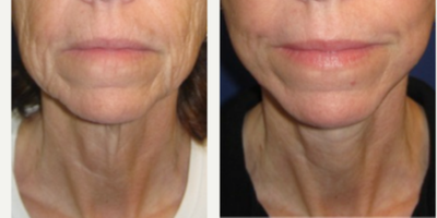 55-64 year old woman treated with Fractional CO2 Laser Skin Resurfacing, Facelift, and a Necklift - This patient came to see me with concerns about the wrinkling of her skin and looseness of her face and neck.  After discussing her concerns and taking the time to understand the aging process of her face and neck, I created a treatment plan that included fractional CO2 laser skin resurfacing, a lower facelift, and a neck lift. The procedure was performed comfortably and safely under local anesthesia. Her recovery was about 7 days. Her pictures are 3 months postop.