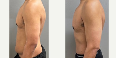 35-44 year old man treated with Male Tummy Tuck - 38 yo male s/p tummy tuck performed in our on site AAAA certified operating suite.
