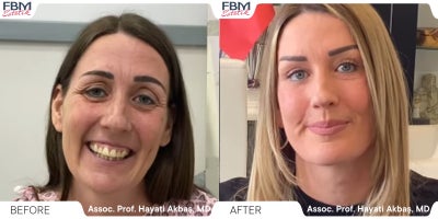 35-44 year old woman treated with Deep Plane Facelift - .
