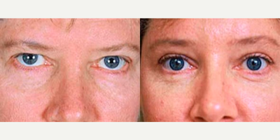 45-54 year old woman treated with Brow Lift - Brow lift & Upper Blepharoplasty