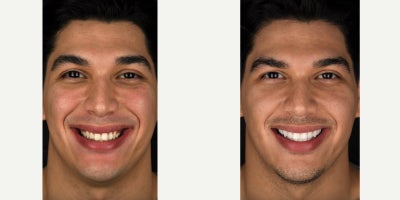 10 Upper and 8 Lower Porcelain Veneers - A Great Smile...the missing link for so many people, holding them back from reaching their full potential. Our patients overall attractiveness is more obvious than ever in the after photo. When people love their smile like never before, inner beauty is awakened. Observe how confidence is now noticeable in the entire face when they smile. Proof that a world-class Smile Makeover is utterly life changing.