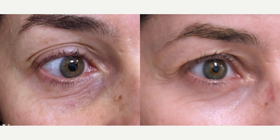 45-54 year old woman treated with DeepFX - Patient was treated with Deep FX to remove dark spots and wrinkles.