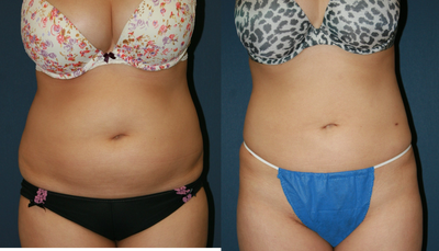 Smartlipo on abdomen and hips. - 36 year old female treated with a combination of Vaser and Smartlipo to her abdomen and hips.