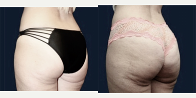 25-34 year old woman treated with Cellfina - Celfina. This is the only FDA cleared minimally invasive one time procedure clinically proven to improve the appearance of cellulite for at least three years .-