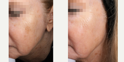 65-74 year old woman treated with Laser Treatment - 70 year old woman treated with LaseMD treatment to target hyperpigmentation