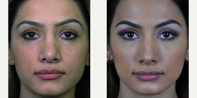 Complex revision open rhinoplasty surgery - This was a complex revision case (prior rhinoplasty performed by a different plastic surgeon) showing changes to her nasal tip and bridge. Getting the nose right from this frontal view is actually the hardest part of any rhinoplasty procedure.