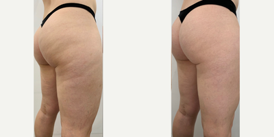 25-34 year old woman treated with Emtone - This fit young woman had never been able to eradicate cellulite despite a low body fat percentage. She was treated with four sessions of Emtone.