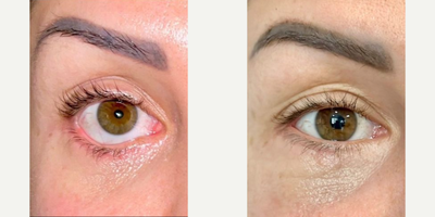Woman treated with Eyelid Retraction Repair - Lower eyelid retraction surgery poses a significant clinical challenge, particularly when it arises as a sequel to midface or lower eyelid surgeries. Scarring emerges as a central issue, and in instances of its presence, the inclusion of anti-scarring agents in conjunction with surgery is recommended to prevent retraction. Additionally, the use of spacer grafts should be considered when necessary. It's important to note that patient outcomes can vary.This is a before and 2 months post-op photo of the patient.