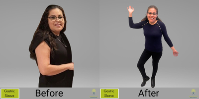 45-54 year old woman treated with Gastric Sleeve Surgery - Small steps lead to big changes. Celebrating every victory. #GastricSleeveJourney