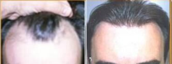 NeoGraft - NeoGraft