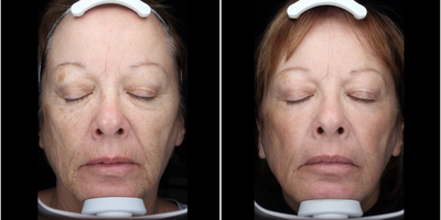 65-74 year old woman treated with Scar Removal, Laser Scar Removal - Patient had a Profractional with PRP done to her whole face and was given post care skin care products