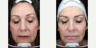 55-64 year old woman treated with Scar Removal, Laser Scar Removal - Patient was treated with full face laser resurfacing