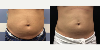 35-44 year old woman treated with UltraShape Power - Results after 3 UltraShape treatments spaced 2 weeks apart.