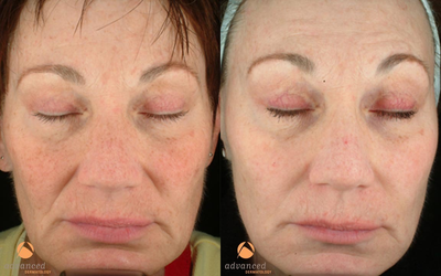 Female treated with 3 Photodynamic Therapy with Levulan for sun damage - 
	Photodynamic therapy (PDT) is the use of light or laser energy to act against sun damage.
