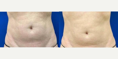 Woman treated with Sofwave - Woman treated with Sofwave.