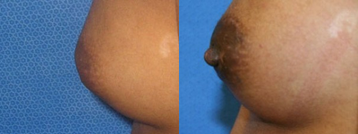 Nipple Surgery - 
	Nipple Eversion
