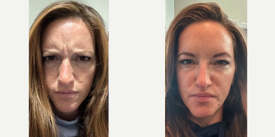 35-44 year old woman treated with Jeuveau - This client had several areas treated with Jeuveau. We treated the forhead, glabella, bunny lines and crows feet.