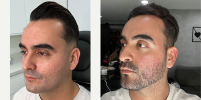 25-34 year old man treated with CO2 Laser, Punch Excision, Fractional Laser - My patient had always dreamed of reducing these harsh scars, which made him feel very self-conscious. He wanted to be treated for years but did not trust anyone in Florida to help him because he knew he was a sensitive skin type.  He had been following me for some time then came to me as soon as he saw that we visit MIAMI.  After one combination treatment, we saw a substantial improvement, but we have a game-plan to target the rest of them. The key is our skincare regimen - it's important to use between treatments.  ACNE SCAR COMBINATION  Punch Excision  Fractional laser  CO2 LASER EmerSkinTAG A BEST FRIEND WHO MAY WANT THIS TREATMENT 
