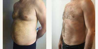 35-44 year old man treated with Liposuction on Chest and Abdomen area - Liposuction on Chest and Abdomen area - The result of 5 months