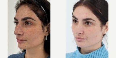 25-34 year old woman treated with Moxi, BroadBand Light (BBL) - 4 weeks after one session of Moxi & BBL.