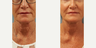 45-54 year old woman treated with Laser Treatment - This patient was treated with Forma laser skin tightening under the chin and neck.