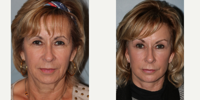 64 year old woman treated with Blue Peel - This patient had a LiteLift, Chin augmentation, Temple lift, Blue Peel, and neck lift were performed simultaneouslyon an out patient basis under general anesthesia.After photos were taken 7 months post-op.