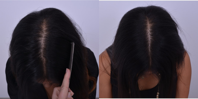 25-34 year old woman treated female pattern Hair Loss with Low-Level Laser Therapy - 27 y/o female suffering from early female pattern hair loss using low-level laser therapy (LLLT) to prevent further hair loss. LLLT is FDA cleared to stop female and male pattern hair loss. One of the benefits of using LLLT is improving overall hair quality. Photos shown are initial photos and 4 months of treatment.