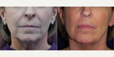 Woman treated with ThermiTight - Woman treated with ThermiTight