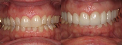 Gum Recontouring - 
	Patient unhappy with smile as a result of poor tooth to gingiva/gum porportion. Gum recontouring resulted in ideal gum to tooth proportion for a enhanced, beautiful smile.
