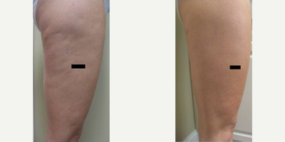 Woman treated with Cellfina - Woman treated with Cellfina