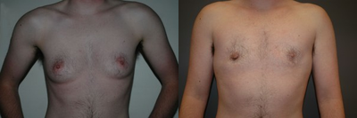 Keyhole approach with incision around areola to tighten and decrease areola size.  - 	Keyhole approach with incision around areola to tighten and decrease areola size. 9 month photo.