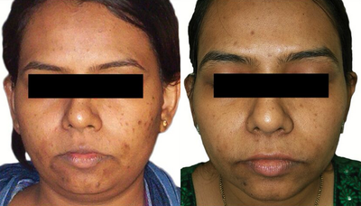 Venus Viva - Before and After 2 Treatments. &nbsp;Photos provided courtesy of Venus Concept, performed by Megha Joy Shah, MD.