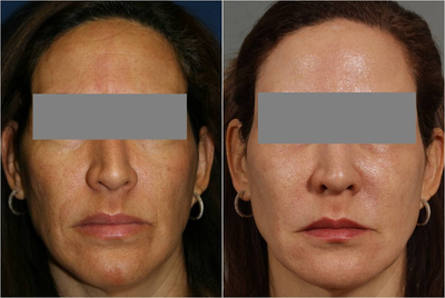 47 year old female treated for melasma, age spots, large pores and rough skin texture - 
	Before: Sun damage with hyper pigmentation, melasma, large pores, fine lines. After: Series of 4 Fraxel Dual 1550 treatments. There was dramatic improvement in skin texture color and pore size reduction. Treatments were done 2 years ago, pre dating Fraxel Dual 1927 technology which would have allowed us to reduce her melasma even further. Patient is scheduled for Fraxel Dual 1927 to add to her results and will cycle every 6 months, Fraxel Dual 1550 for the pores, lines, textures and Fraxel Dual 1927 for pigmentary issues.
