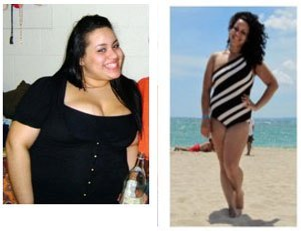24 years old female, treated with sleeve gastrectomy - 24 years old female ,  treated which with a  sleeve gastrectomy. she had 230 pounds at the time of surgery, with a lot of obesity associated diseasses . this it is  her  3 years after  surgery. she  weighs 138 pounds  (down  92 pounds) (size 16 before/ size 4 now) and is a new and happy  person.