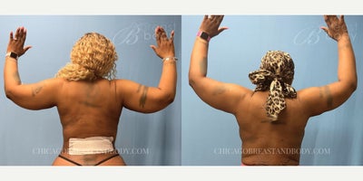 35-44 year old woman treated with Liposuction, Renuvion - Upper arm liposuction with renuvion procedure by Dr. Pey-Yi Kevin Lin.