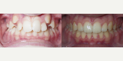 17 or under year old woman treated with Damon Braces - Severely crowded case with blocked Cuspid teeth erupted out of position.