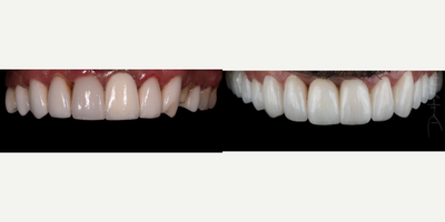 25-34 year old man treated with Dental Bridge - Upper and lower porcelain veneers added to correct alignment, bite and aesthetic concerns. By enhancing the smile and increasing the dimension from top to bottom, anti-aging affects can be seen.