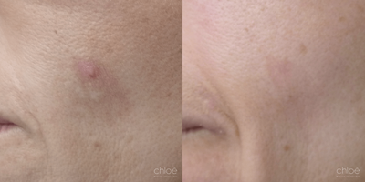 Face Age Spots Treatment using Chemical Peel - Solar lentigos, commonly called dark spots or age spots, are flat brown spots caused by sun exposure. They may be present all over the body surface, especially in the areas most exposed to UV rays. This condition can be effectively treated with chemical peels.