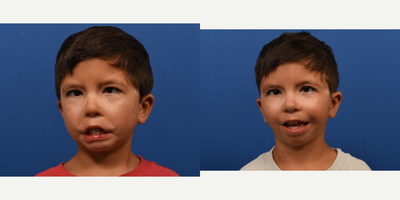 Facial Reconstructive Surgery - Facial Reconstructive Surgery