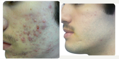 25-34 year old man treated with Spironolactone For Acne, Laser Resurfacing, CO2 Laser, YAG Laser, Fractional Laser, UltraPulse C - A safe and effective way to treat acne (even cases resistant to conventional therapies), improve the skin and minimize scar formation.What are the benefits?Laser acne treatment offers a no down-time approach to help clear acne lesions and help reduce severity of future breakouts. You can return to work or school immediately after treatment. The only side effect will be slight facial redness. Laser treatments do not have the side effects seen with oral and topical treatments. Laser treatment DO NOT induce prolonged dryness, severe redness, or mental depression.How does it work?Dr. Rafael Diaz-Yoserev will analyze your skin condition and help you select the most effective treatment for you.When will you see results?Effects are cumulative. After the first treatment, you might see improvements. The number of lesions and severity of breakouts should reduce over the course of treatments and beyond. Some patients continue to improve two months after their last treatment.How often can you have it done?The typical course of treatments is 2-3 weeks, 2-3 treatments per week.