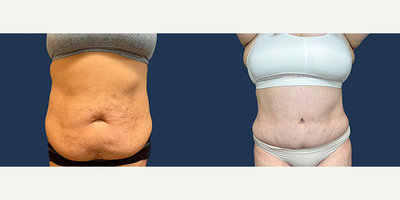 35-44 year old woman treated with Liposuction, Panniculectomy - 35-44 year old woman treated with Liposuction, Panniculectomy