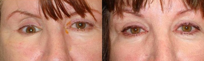 A middle aged woman with sunken right eye from trauma who underwent surgery with orbital implant. - A middle aged woman with sunken right eye (enophthalmos) from trauma who underwent surgery with orbital implant. Note the significant improvement of right eyeball position after surgery.