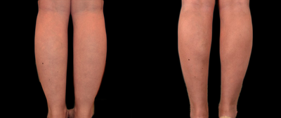 35-44 year old woman treated with Body Jet - vaser and body jet liposculpture of the thighs/legs in a patient with lipedema. see the transition from before, 2 weeks and 6 weeks after treatment.