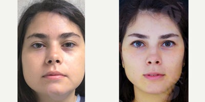 25-34 year old woman treated with Buccal Fat Removal - 25-34 year old female treated with Buccal Fat Removal