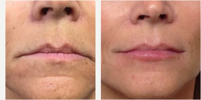 45-54 year old woman treated with Volbella - 54 year old Female Used 2 syringes of Juvederm Volbella to increase volume in patient's pink lip, fix asymmetry, lift the corners of the mouth and give the lips an overall more youthful look. After photos taken 3 weeks post injection.