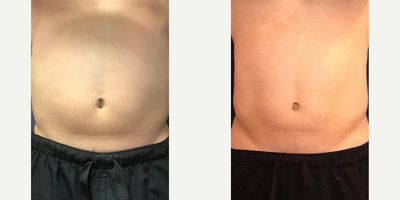 Man treated with SculpSure - Man treated with SculpSure
