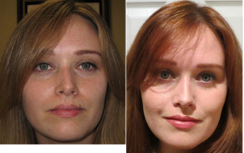 mole removal - 
	mole Removal
